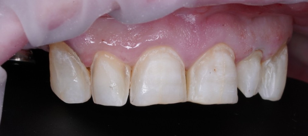 Gentle tooth preparation for veneers by Foxley Lane Dental in Purley – minimal enamel removal for safe, natural-looking cosmetic results. A UK alternative to aggressive ‘Turkey teeth’ filing.
