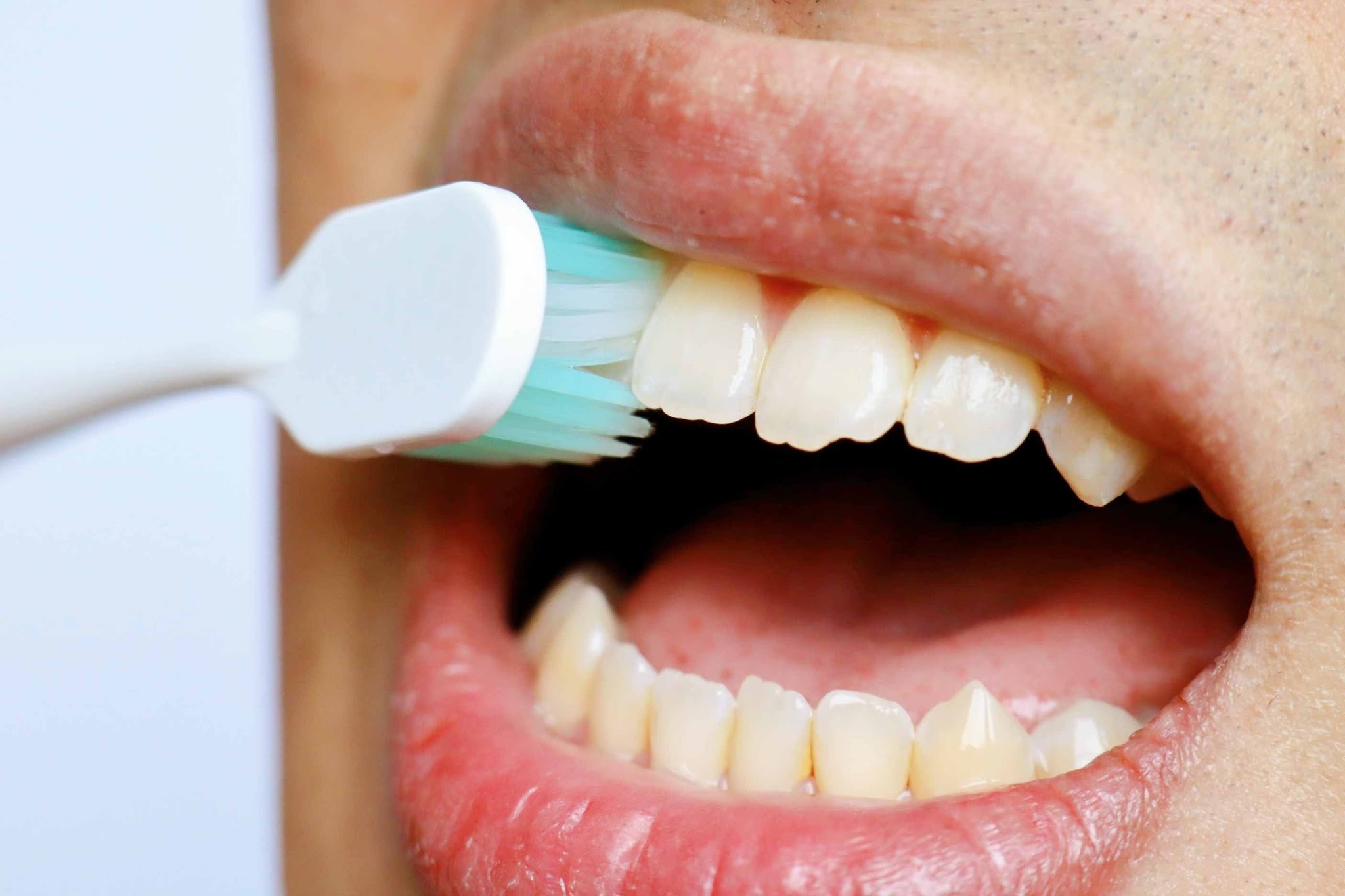 Worn and uneven front teeth before worn teeth treatment in Purley