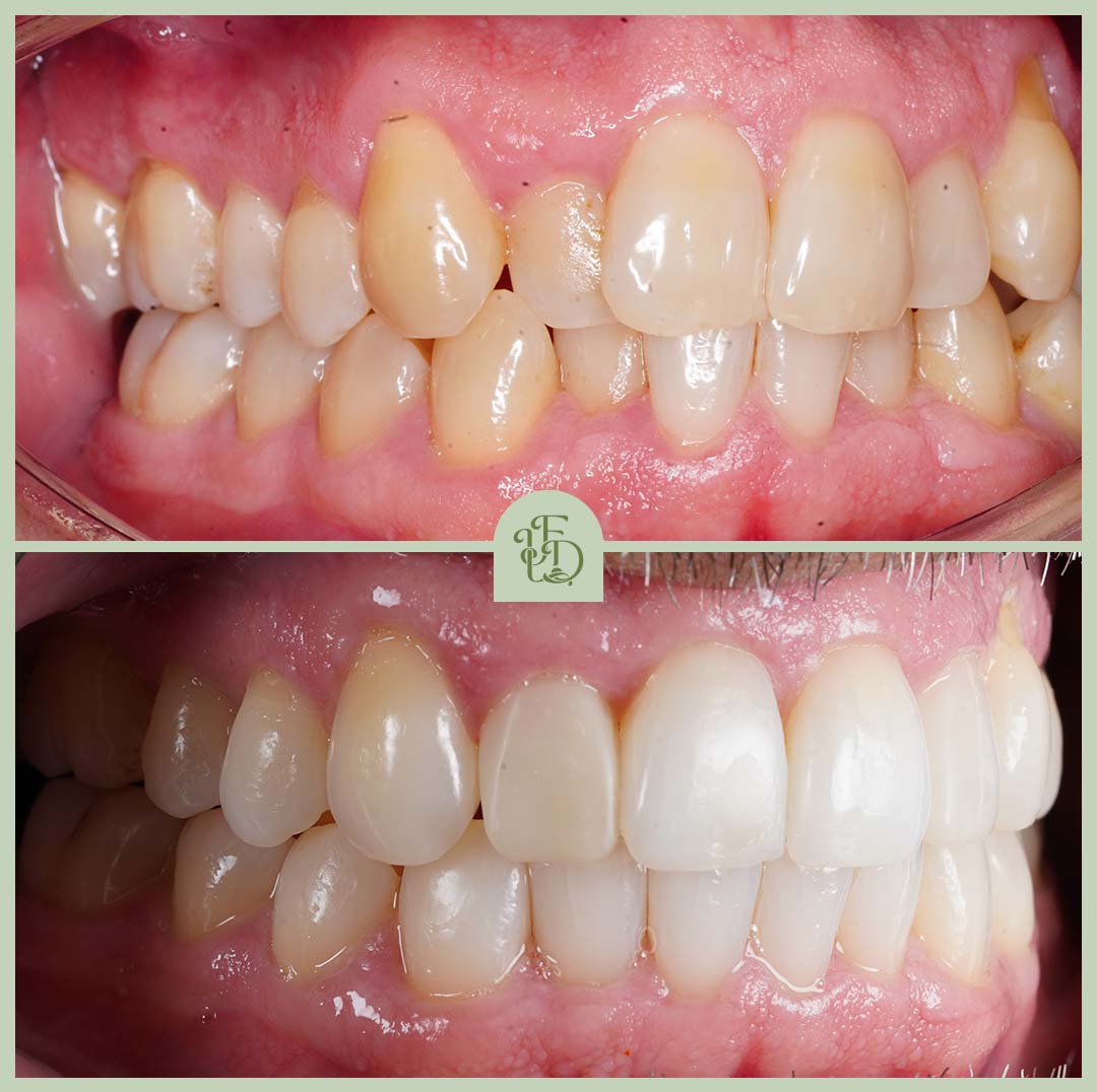 Before and after Purley Invisalign treatment correcting crowded teeth and improving the bite for a straighter, healthier smile.