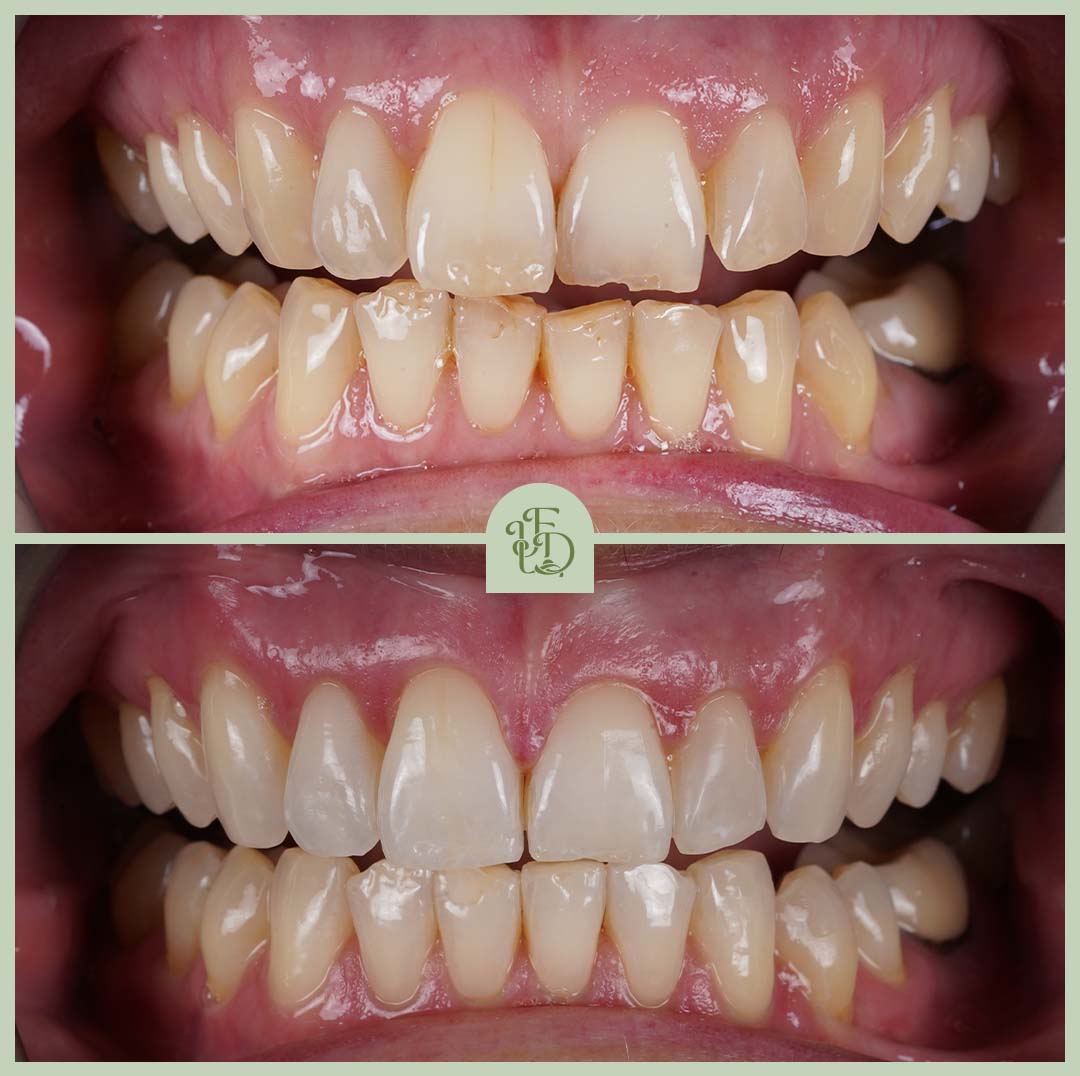 Results from Invisalign Purley, improving tooth alignment and creating a straighter, healthier smile with treatment at Foxley Lane Dental