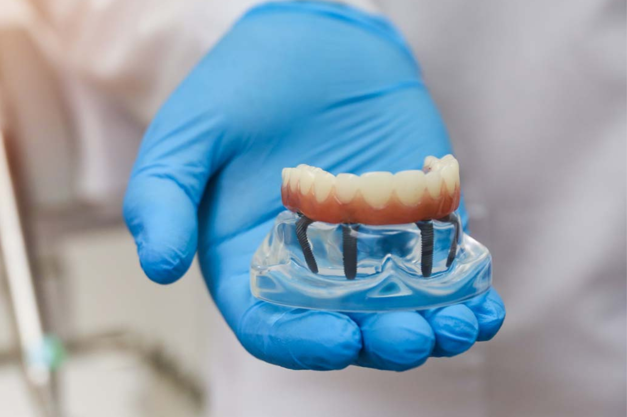Model of full mouth dental implants with implant retained bridge used for All-on-4 treatment in Purley