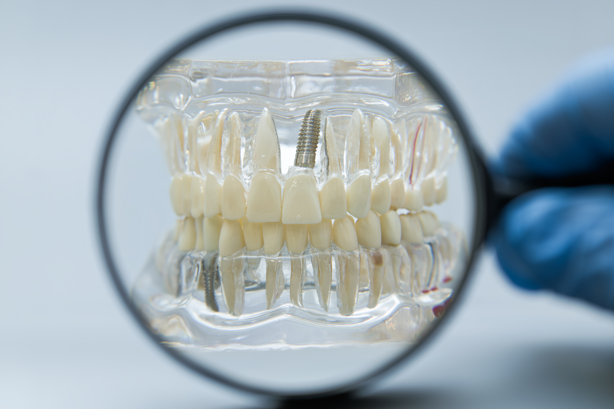 Close-up dental implant model showing titanium implant post used for missing tooth replacement and full mouth implant treatment