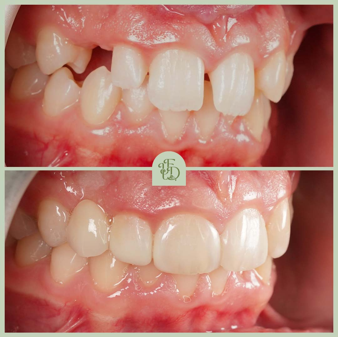Before and after composite bonding treatment at Foxley Lane Dental in Purley, South London. The top image shows chipped, uneven and misaligned front teeth with gaps, while the bottom image reveals the finished result after bonding - smooth, even, natural-looking teeth with improved shape, colour and alignment. Composite bonding is a fast, minimally invasive treatment that restores confidence and delivers a seamless smile.