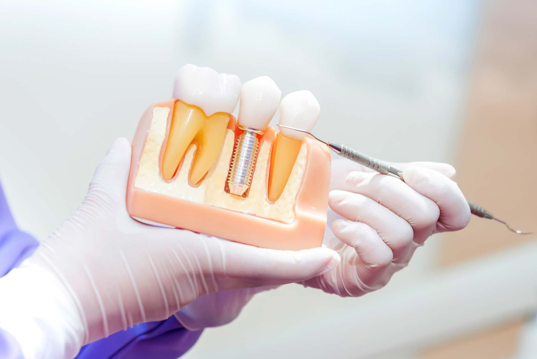 Dental implant model showing titanium implant post and crown used to replace a missing tooth