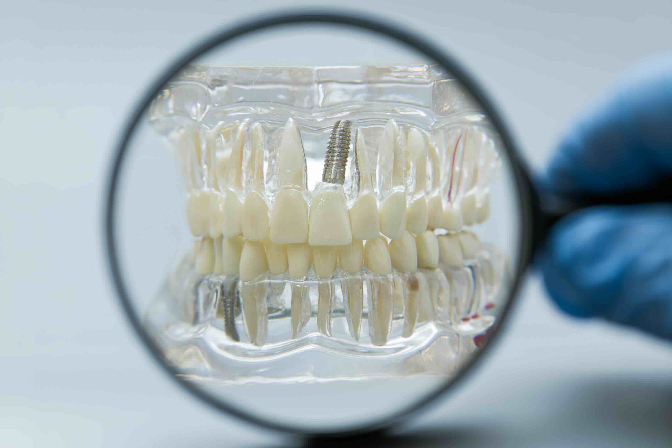 Dental implant model showing replacement tooth for patients near Caterham