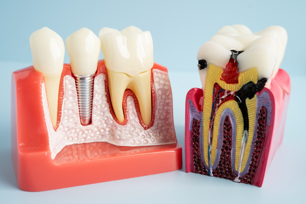 Dental models showing a natural tooth, dental implant and infected tooth