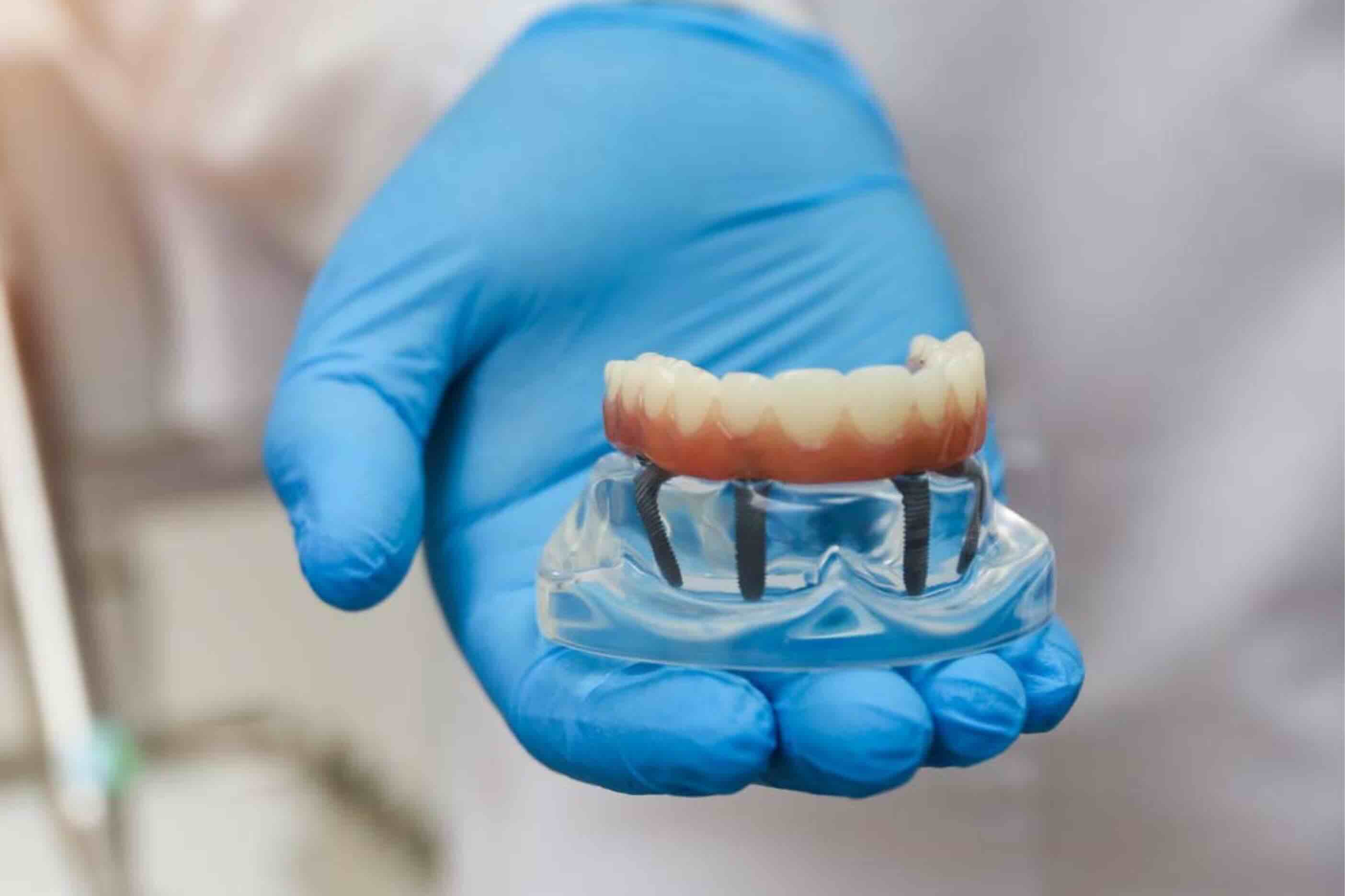 Implant-supported denture model demonstrating full arch dental implants near Sanderstead
