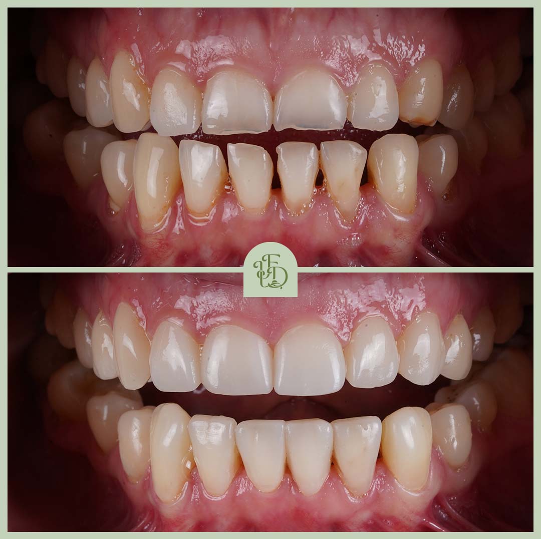 Before and after Purley Invisalign treatment showing straighter, more even teeth with improved bite alignment.