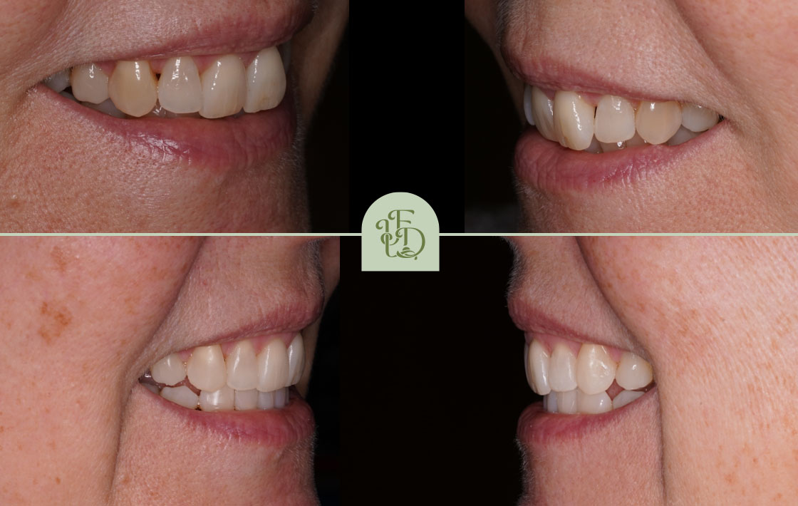 An Invisalign before and after image showing the progression to straight teeth on a female patient