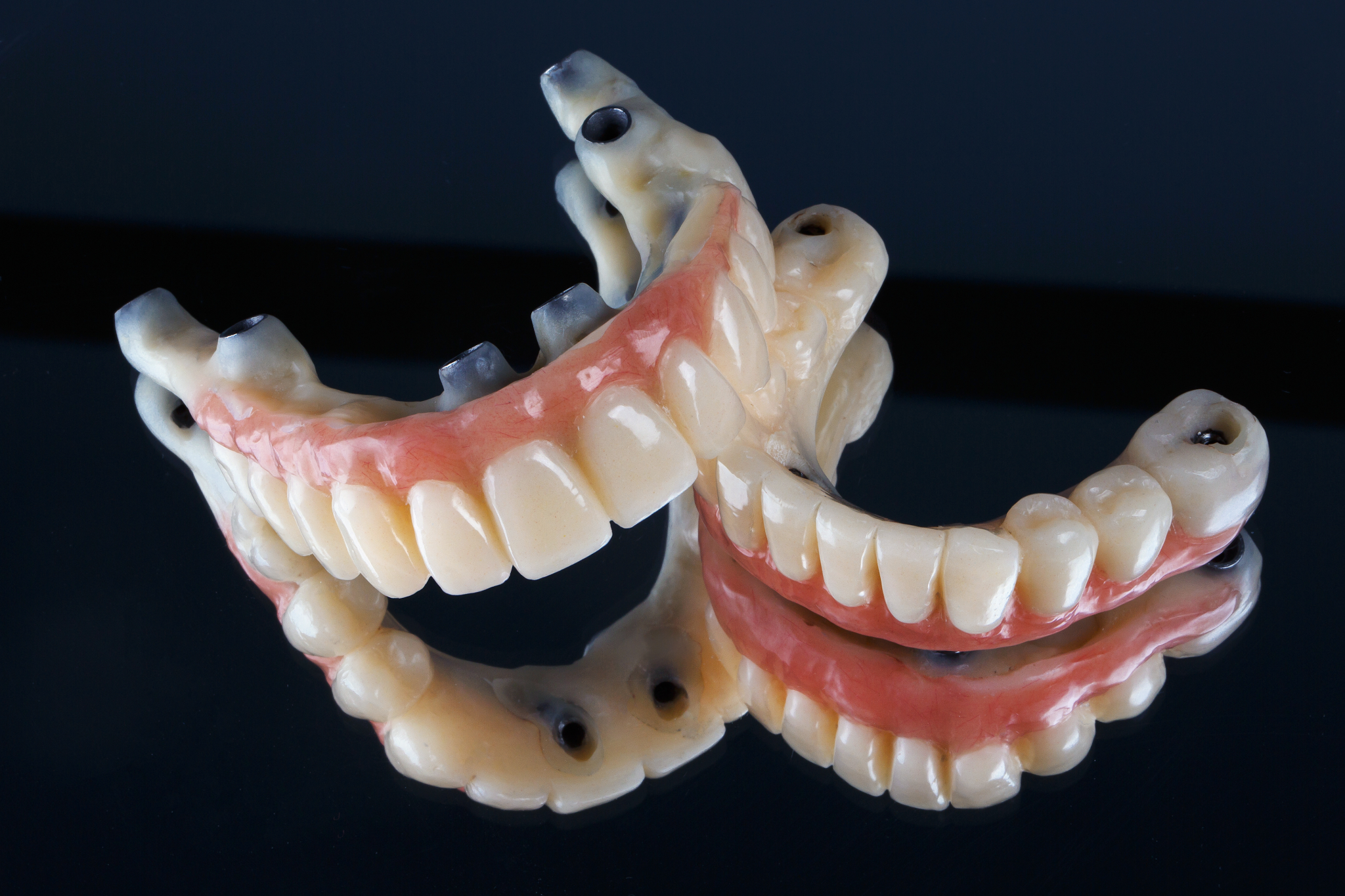 Full mouth dental implant bridge model showing All-on-4 style full mouth dental implants in Purley