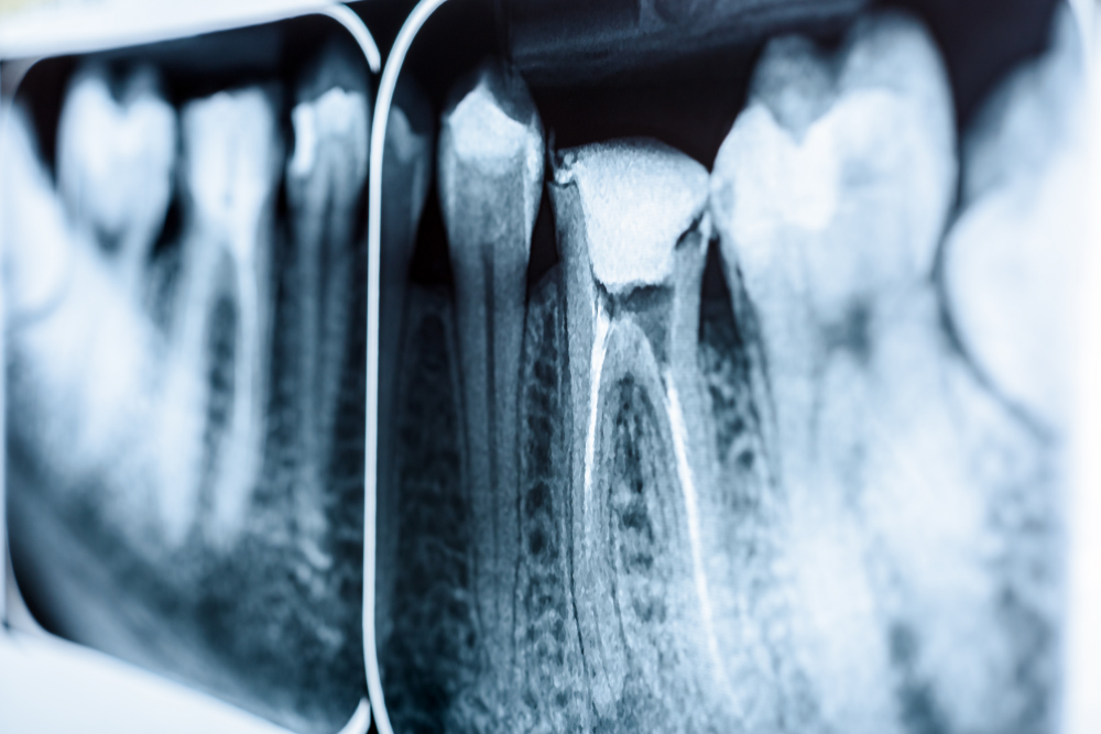 Dental X-ray showing a tooth that has undergone root canal treatment