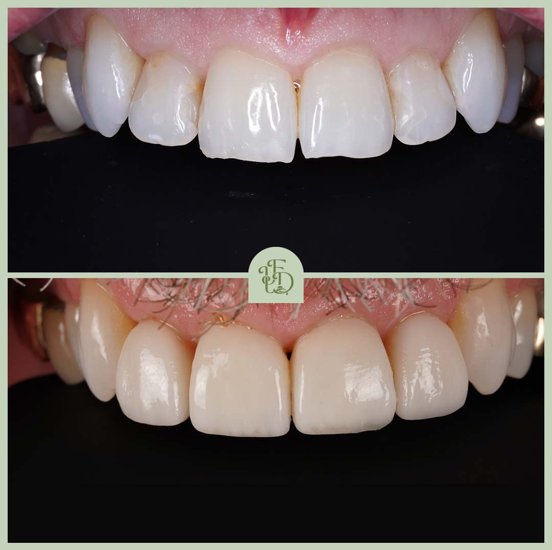 Before and after porcelain veneers at Foxley Lane Dental in Purley. The top image shows worn, uneven, and discoloured teeth, while the bottom image reveals the final result with veneers - a smooth, even, natural-looking smile.