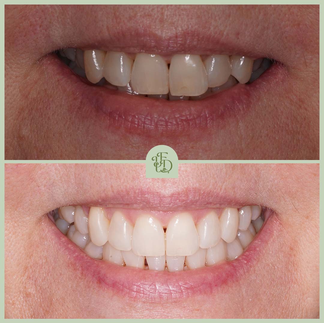 Before and after at Foxley Lane Dental in Purley Invisalign treatment, closing gaps and straightening teeth for a confident smile.